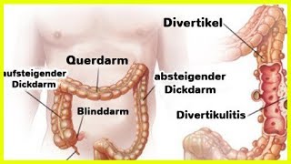 Divertikulitis und Divertikulose – Was ist das und welche Behandlungen gibt es [upl. by Aitetel]