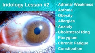 Iridology Lesson  Gland Weaknesses Allergies Anxiety Fatigue Asthma and How to Heal [upl. by Eanat]