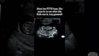 Baby movement in womb pregnancycare pregnancy ultrasound [upl. by Ynad]