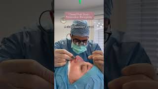 Hump removal in Push Down Preservation Rhinoplasty  Dr med Simon Zimmermann [upl. by Immas771]