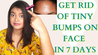 How to Get Rid of Tiny Bumps on Face Naturally  Home Remedy To Treat Fungal Acne  Remove Tiny Bump [upl. by Banky169]