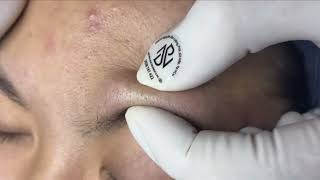 Relax EveryDay With Nhat Bang Spa 2024 Blackheads Removal On Teen [upl. by Trotter]