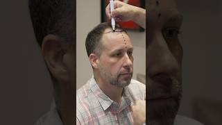 Cosmedica Clinic Hair Transplant in Turkey shorts hairtransplant video [upl. by Neraj]