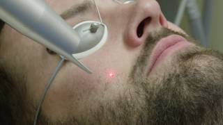 Medlite C6 1064 Laser Facial  Reno Sparks MedSpa  Dr Calvin Van Reken [upl. by Ettennahs]