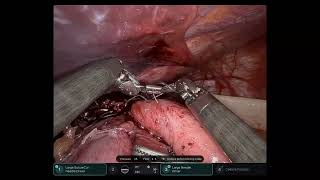 Robotic Toupet Fundoplication Technique [upl. by Steel]