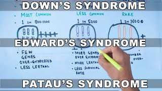 Trisomy  Downs vs Edwards vs Pataus Syndrome [upl. by Elspet]