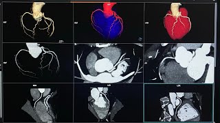 CTA CORONARY  Siemens 128 Somatom goTop  65 ml Contrast flow rate 53  HMS MIRDIF HOSPITAL [upl. by Noyr]