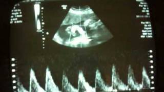 Fetal heart rate  32 week ultrasound [upl. by Alahsal89]