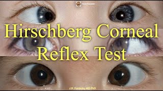 Hirschberg Corneal Reflex Test Principles and Procedure [upl. by Neoma]