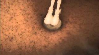 NonSurgical Keloid Treatment with Cryotherapy [upl. by Einra]