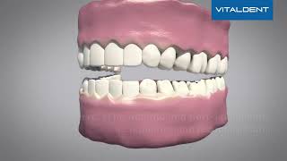 Descubre cómo funciona la Reconstrucción Dental en Vitaldent [upl. by Naltiac]