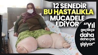 Fil Hastası Lenfödem Hastalığı Kadının Yardım Çığlığı Çare Bulsunlar Bana [upl. by Drallim611]