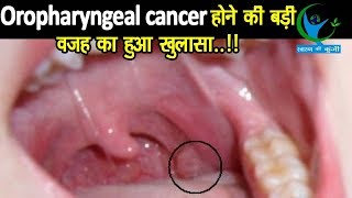 Oropharyngeal Cancer मुख और गले के कैंसर मरीजों के आंकड़ों को सुनकर दंग रह जायेंगे लक्षण और उपचार [upl. by Selrac]