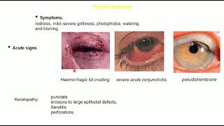 Stevens–Johnson syndrome and MMP [upl. by Annerb]