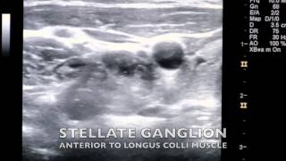 Ultrasound Guided Stellate Ganglion Block [upl. by Okimik802]