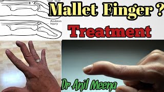 mallet finger treatment  mallet finger treatment at home  mallet finger exercises  in hindi [upl. by Peh200]