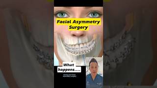 Facial Asymmetry Surgery What to Expect dentallan shorts dentist [upl. by Joe]