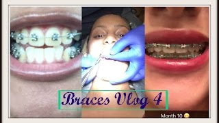 BRACES VLOG 4  Months 410 Ortho visit Rubberbands powerchains [upl. by Regan]