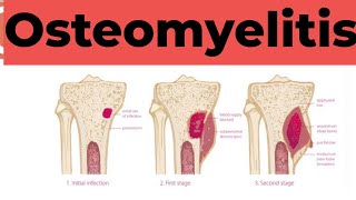 Osteomyelitis  Causes Sign and Symptoms Diagnosis amp Treatment Pathology [upl. by Jackson]