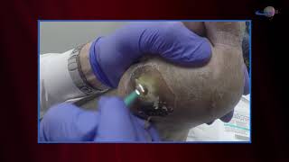 WCW Managing Diabetic Foot Ulcers  Debridement and Classifying Ulcers [upl. by Rawdan]