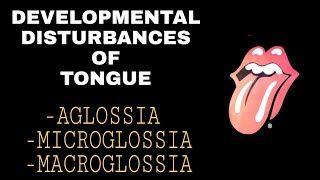 DEVELOPMENTAL DISTURBANCES OF THE TONGUE  AGLOSSIA  MICROGLOSSIA MACROGLOSSIA [upl. by Airehc445]