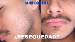 ¿CÓMO QUITAR LA RESEQUEDAD DEL MINOXIDIL EN LA BARBA [upl. by Eisler831]