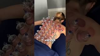 Cupping Therapy Explanation [upl. by Nelo]