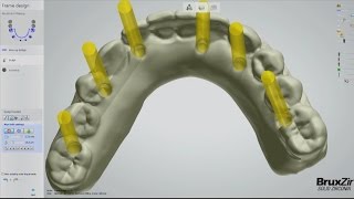 Fabrication of the BruxZir® FullArch Implant Prosthesis Vol 1 Issue 2 [upl. by Cockburn]