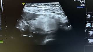 Ultrasound of panniculitis [upl. by Arahs]