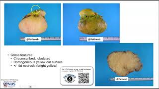 Musculoskeletal system Lipoma Gross pathology [upl. by Noruq]