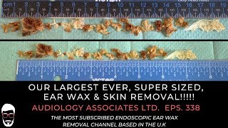 OUR LARGEST EVER SUPER SIZED EAR WAX amp SKIN REMOVAL  EP 338 [upl. by Yelyah]