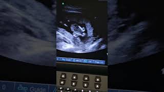 145 week fetal ultrasound [upl. by Hada]