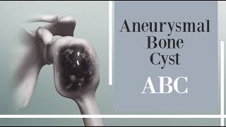 What is an Aneurysmal Bone Cyst Symptoms Causes Diagnosis and Treatment [upl. by Hospers405]