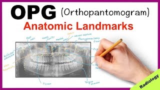 Orthopantomogram OPG Anatomical Landmarks  Radiology [upl. by Daveda]