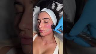 Forma Skin Tightening Procedure  Avance Plastic Surgery Dr Erez Dayan  Reno Tahoe NV [upl. by Neyugn]