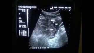 LT OVARIAN CYST with SOLID fixed area in it [upl. by Itsirk20]