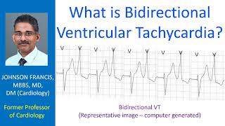 What is bidirectional ventricular tachycardia [upl. by Aerdnat]