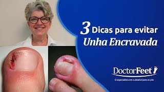 3 DICAS IMPERDÍVEIS PARA EVITAR A UNHA ENCRAVADA [upl. by Richer]