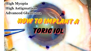 Basics of TORIC IOL [upl. by Yenahpets162]