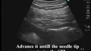 Ultrasoundguided pudendal nerve block [upl. by Campy949]