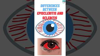 What are the Differences Between Episcleritis and Scleritis rheumatoidarthritisautoimmunediseases [upl. by Aicnerolf]