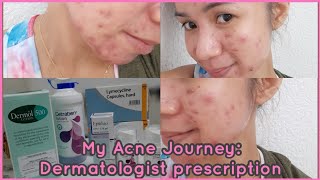 My Acne Journey Lymecycline Capsules Epiduo Gel Dermol 500 amp Cetraben Lotion  Gel Pines [upl. by Noirad]