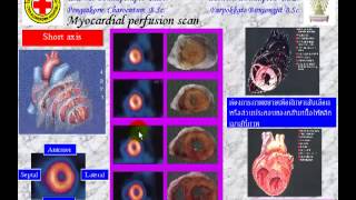 NMChula Radionuclide Imaging Technique 7 [upl. by Tiat]