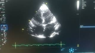 ALL FOUR CHAMBERS DILATED GLOBAL HYPOKINESIA OF LV MILD MR SEVERE LV MODERATE TR [upl. by Yrian]