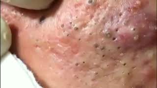 Best Blackhead Removal Ever 2020 [upl. by Llenyl]