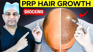 PRP Hair Loss Treatment Before and After Success Stories [upl. by Ayanad2]