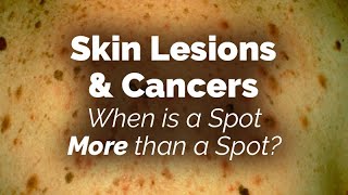 When is a Spot More than a Spot Skin Lesions and Cancers [upl. by Sirdna]