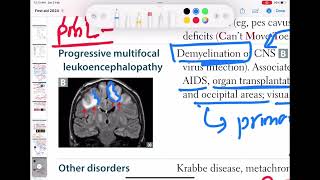 Progressive multifocal leukoencephalopathy neurology 117  First Aid USMLE Step 1 in UrduHindi [upl. by Atihcnoc]