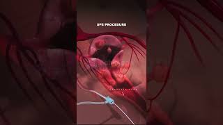 What is Uterine Fibroid Embolization procedure Types of Fibroids fibroid pregnancy animation [upl. by Ahsienahs756]