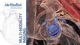 Evaluating Prosthetic Heart Valves w EchoDoppler Zoghbi MD Chang MD Shah MD April 21 2020 [upl. by Brigid]